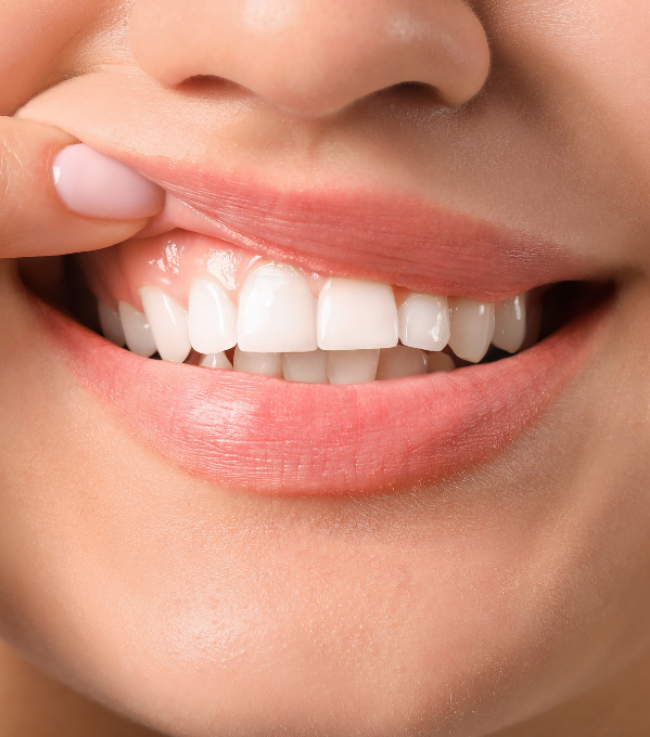 gingivitis-parodontitis