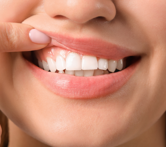 Peri-Implantitis en Mucositis